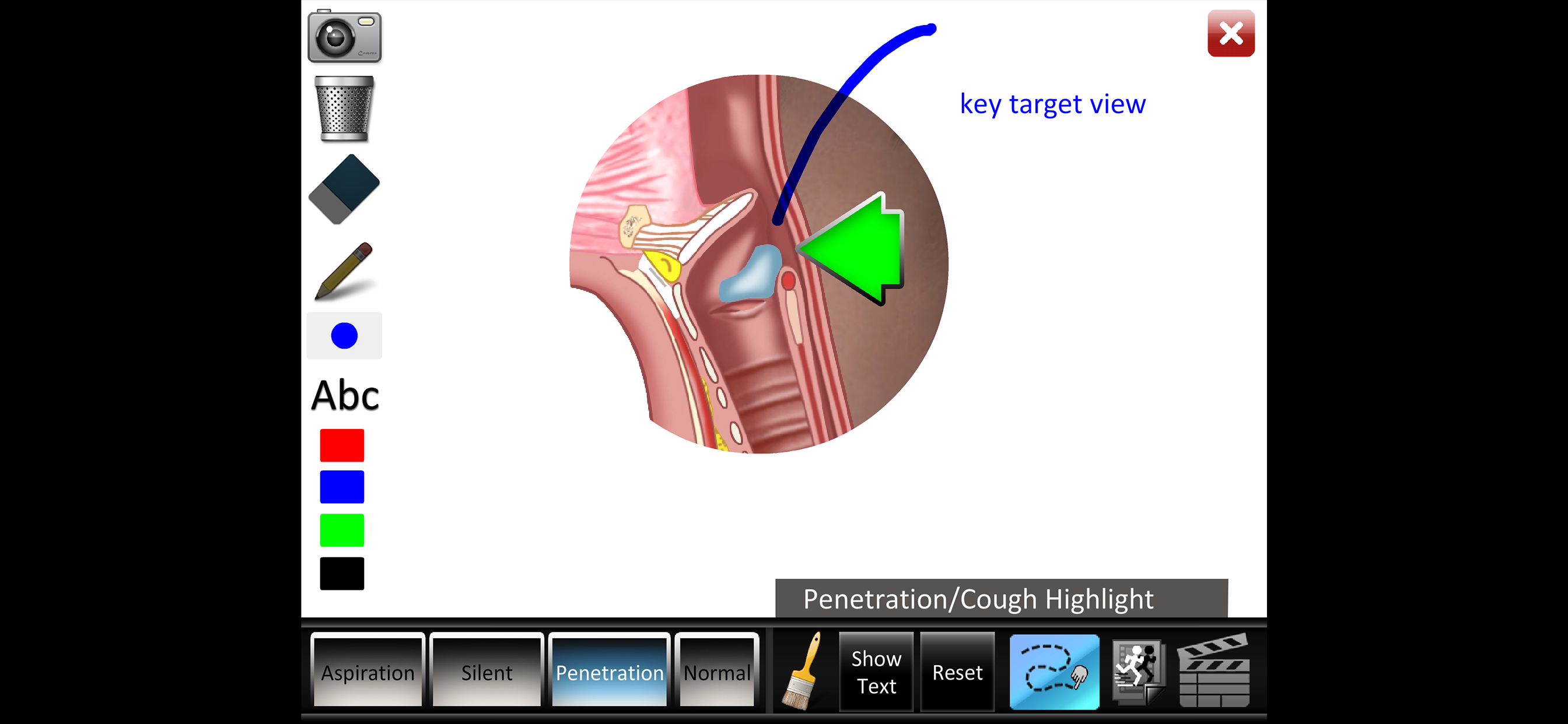 Aspiration Disorders screenshot 5