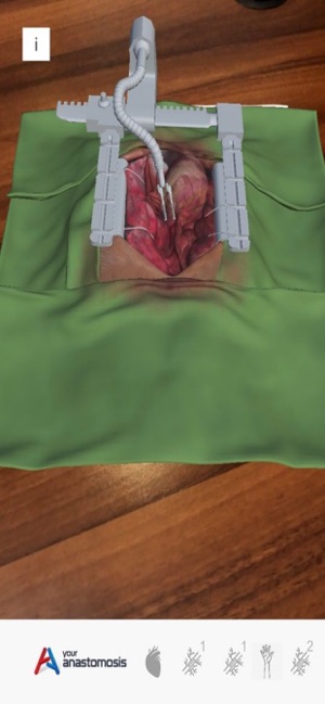 Youranastomosis