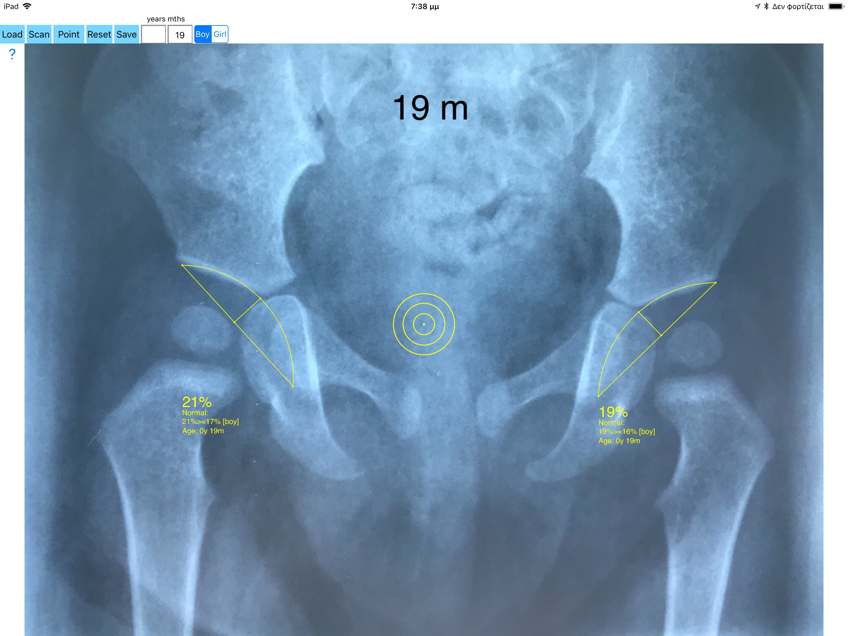 AcetabularDepthRatioApp screenshot 18