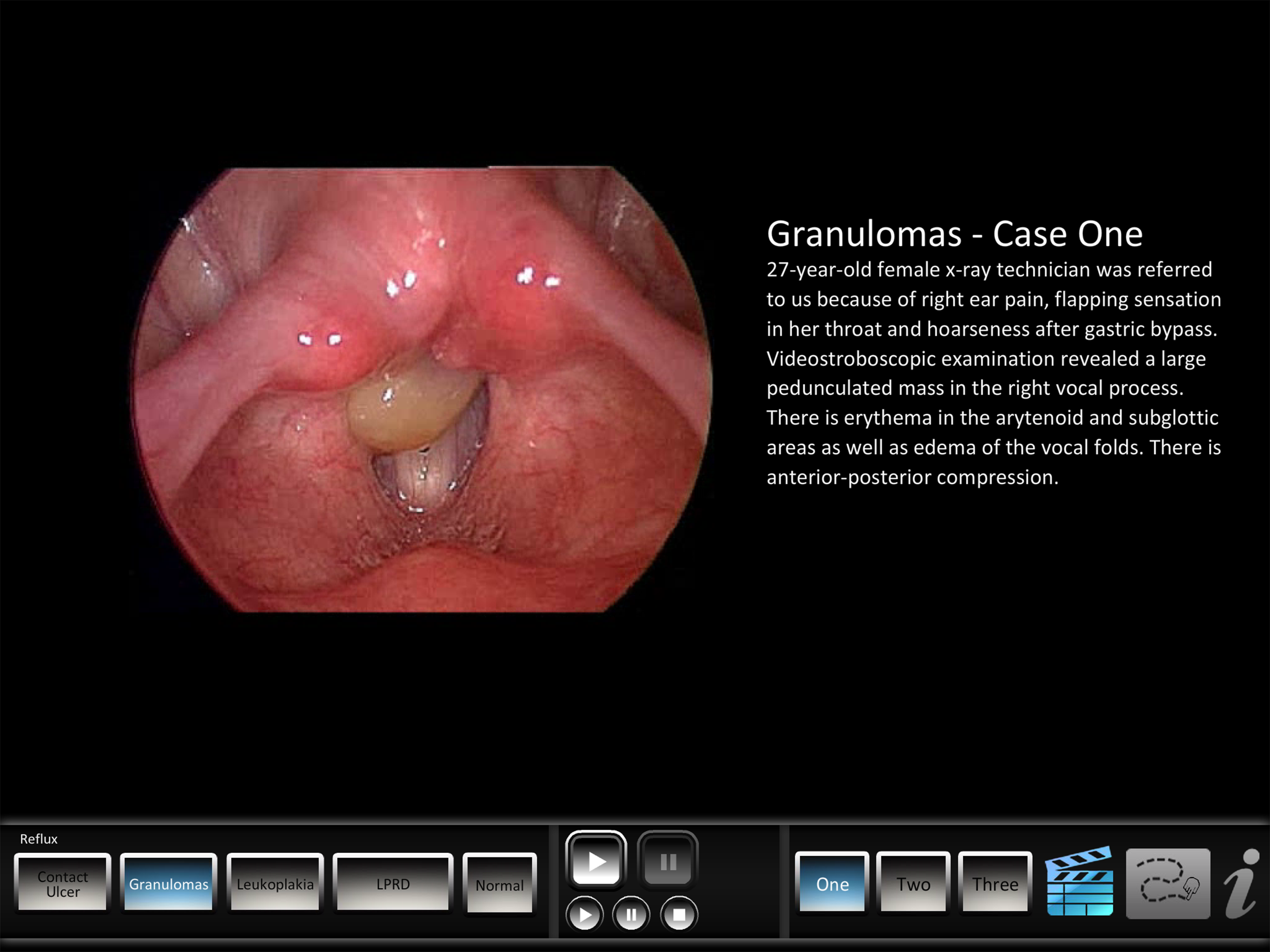 Vocal Pathology: Reflux screenshot 9