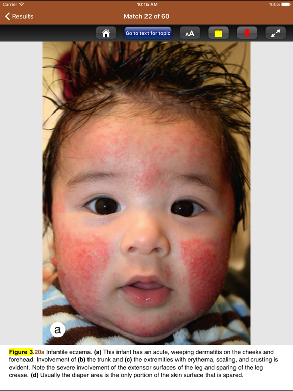 Screenshot #4 for Cohen Pediatric Dermatology 4E