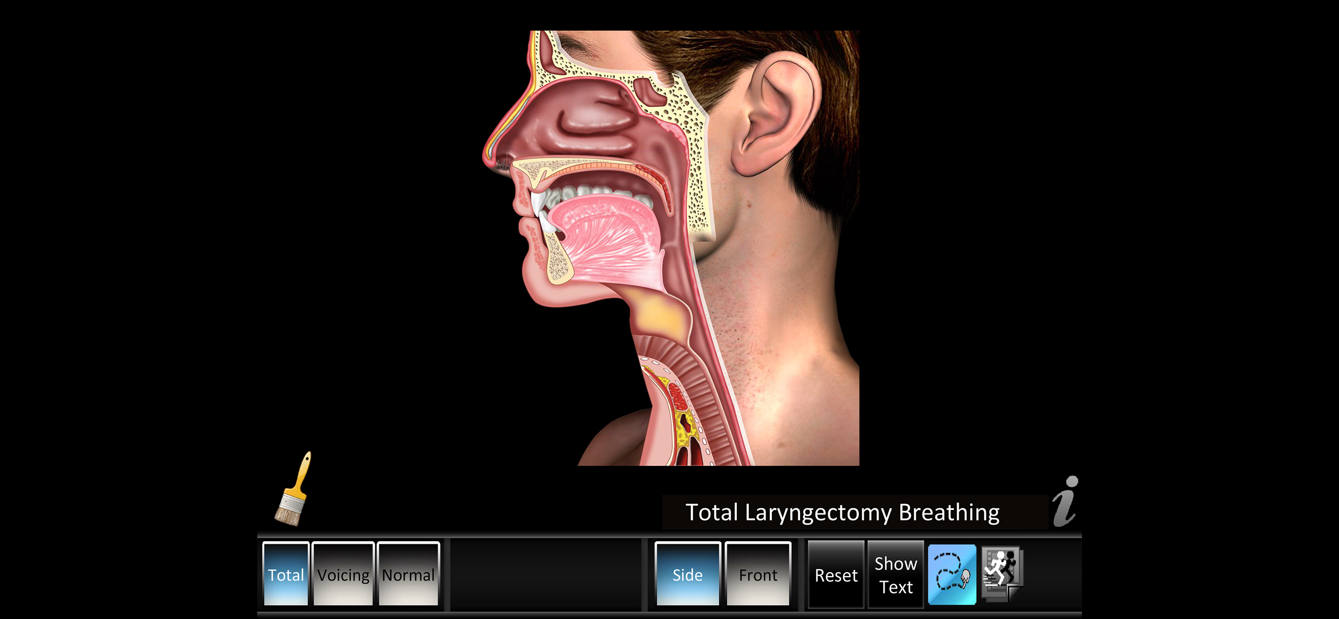 Laryngectomy