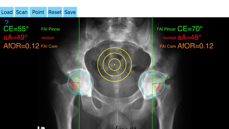 FemoroAcetabularImpingementApp screenshot-0