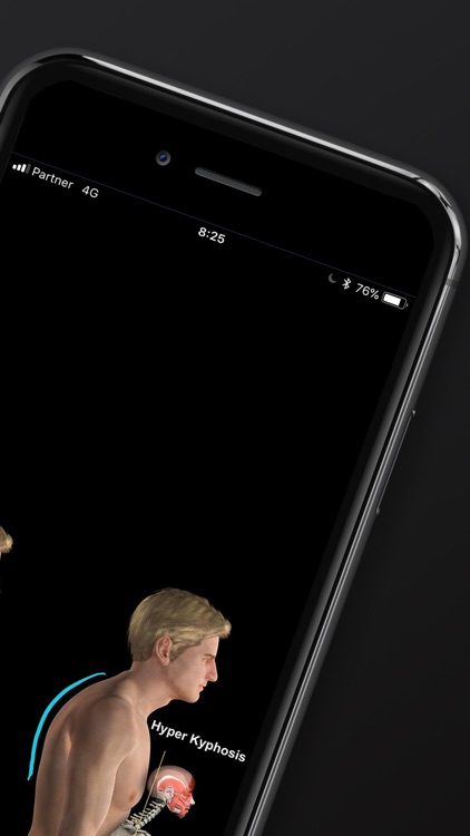 Kyphosis & Rounded Back