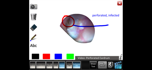 Otitis Media Disorders screenshot 5