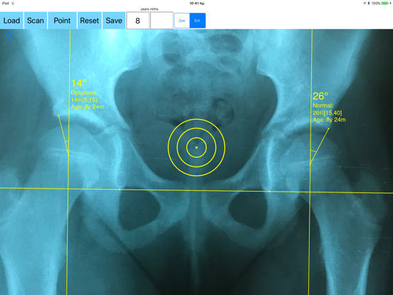 Screenshot #5 pour CenterEdgeAngleApp