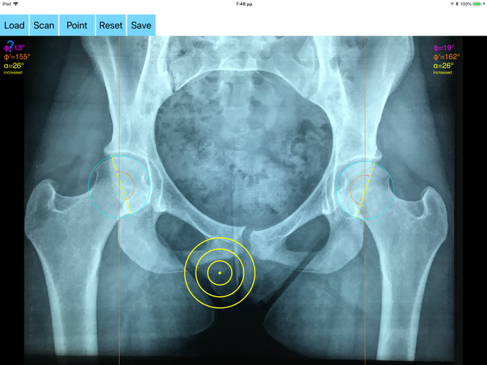 AcetabularAnteversionApp