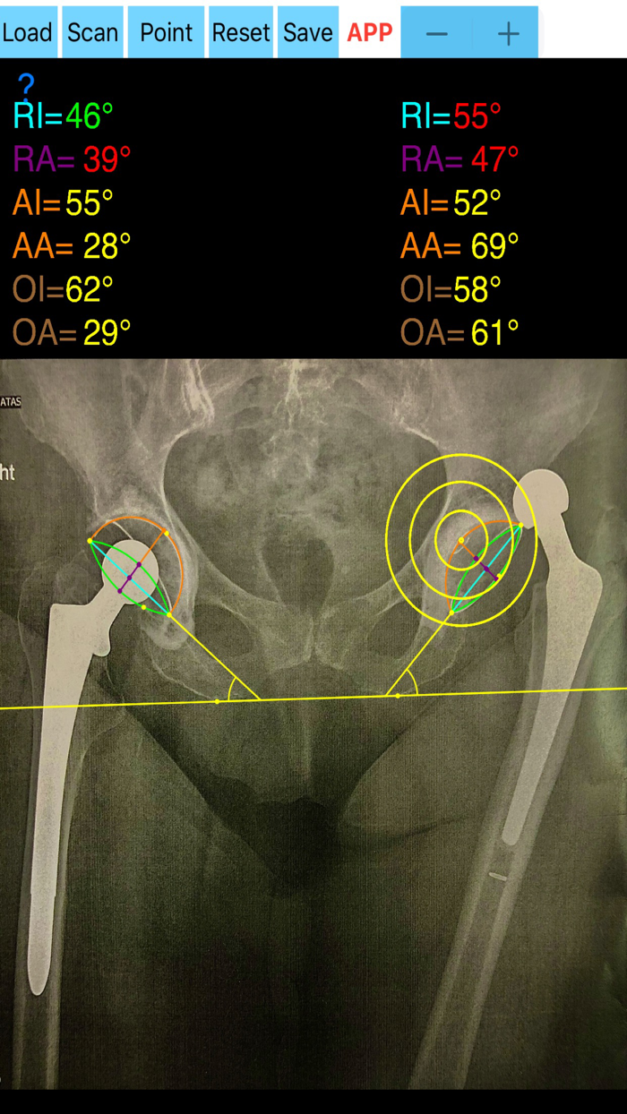 CupAnteversionInclinationApp