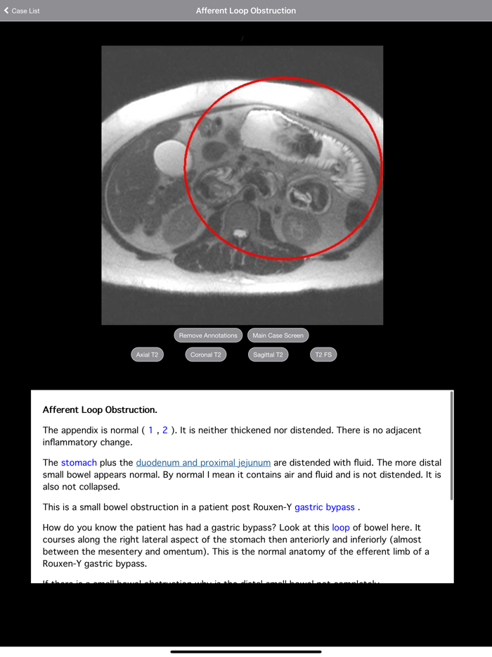 Pregnant Appendicitis