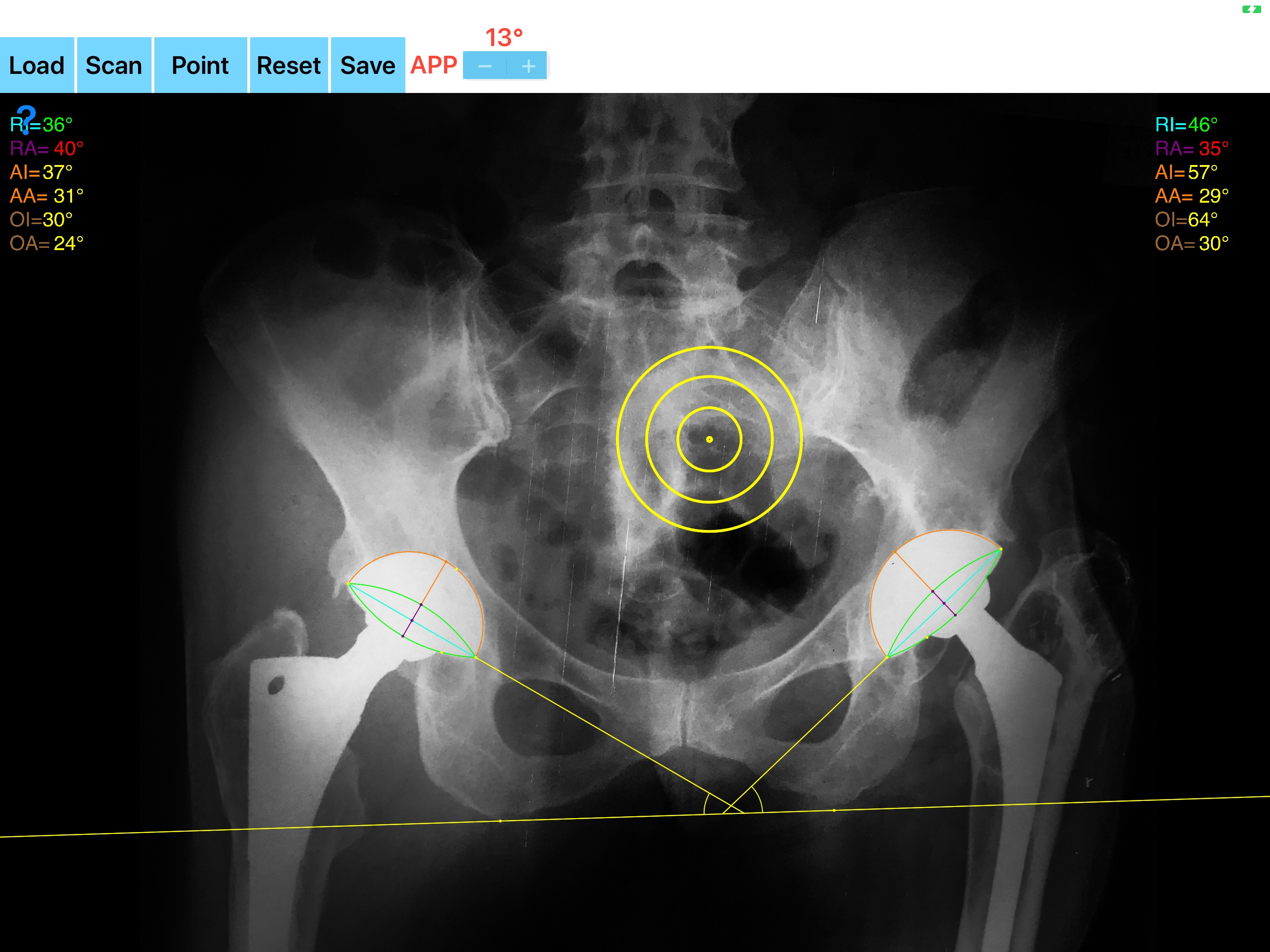 CupAnteversionInclinationApp screenshot 14