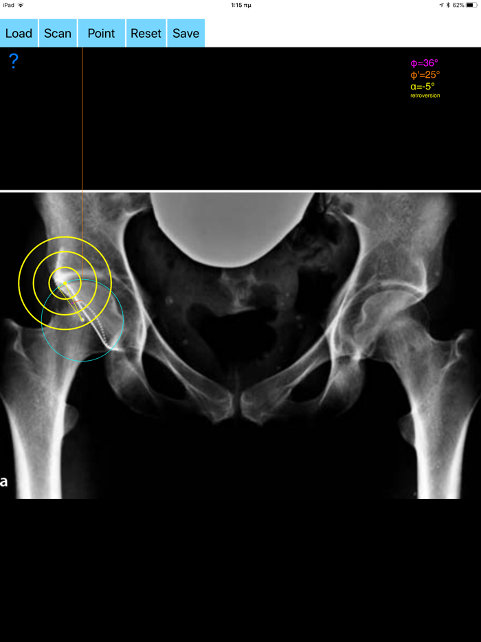 AcetabularAnteversionApp