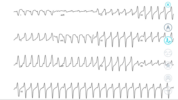Cardiac Arrhythmia Challenge screenshot-3