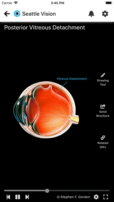 Eye GIFs - Patient Education Screenshot