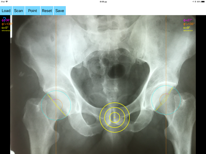 AcetabularAnteversionApp