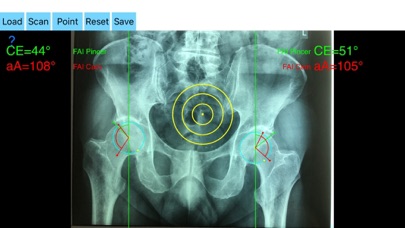 FemoroAcetabularImpingementApp Screenshot