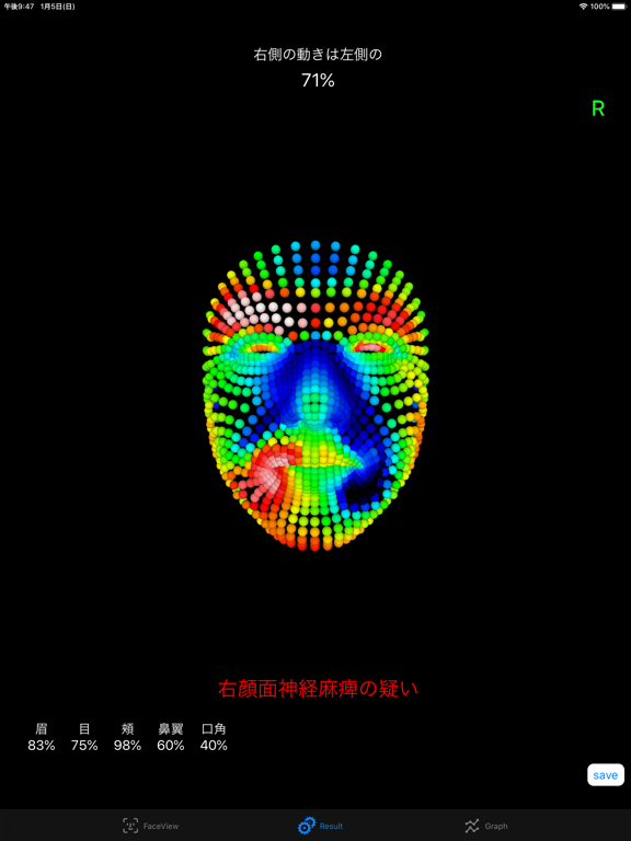 Screenshot #5 pour FacialPalsyZero