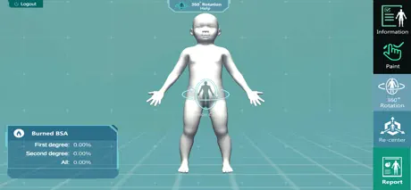 3D PED Burn Resuscitation