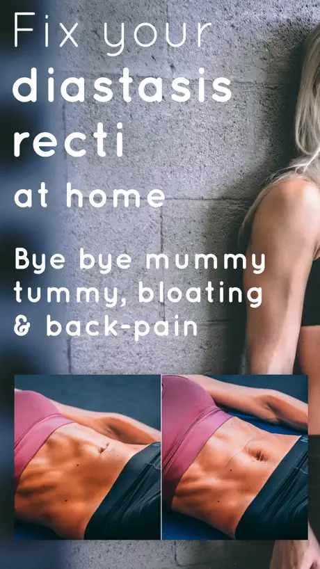 Diastasis Recti Fix