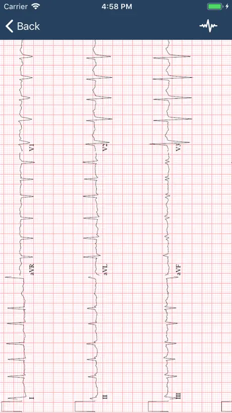ECG Guide