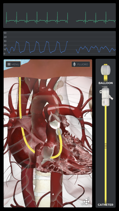 Mentice Right Heart Cath Screenshot