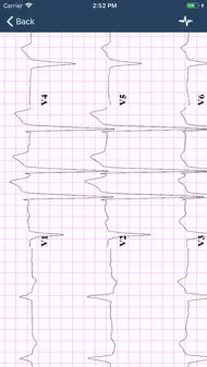 ECG Guide iphone bilder 3