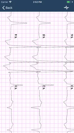ECG Guide iPhone image 3
