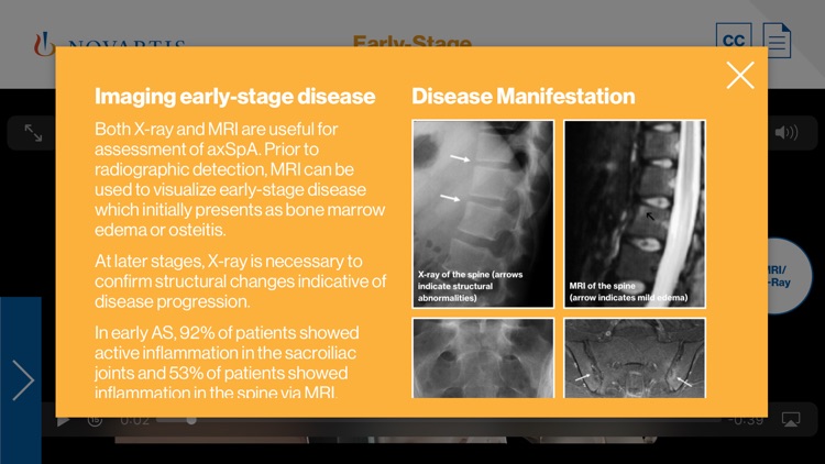 AS Progression Visualizer by Novartis Pharmaceuticals Corporation
