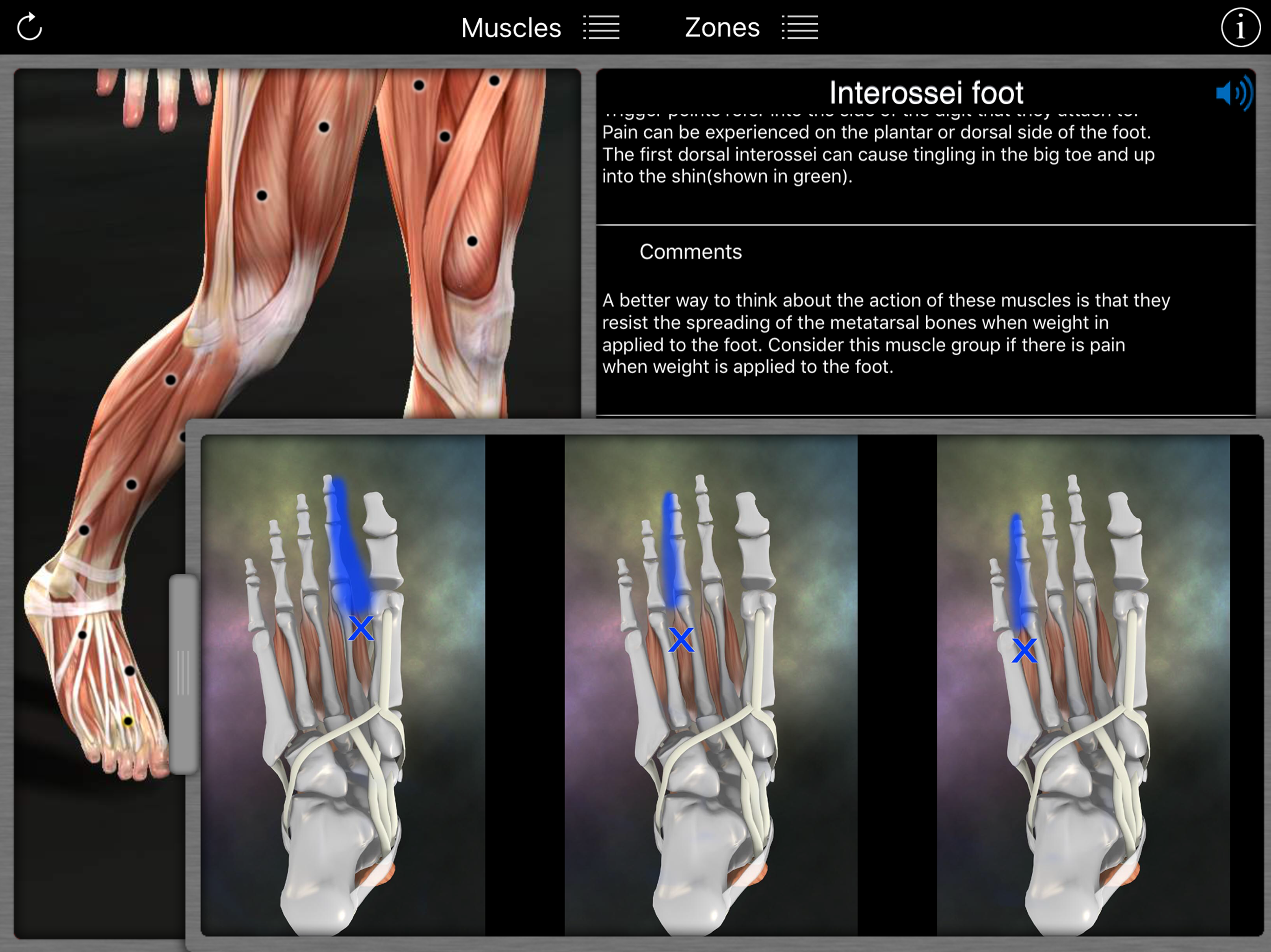 Muscle Trigger Points