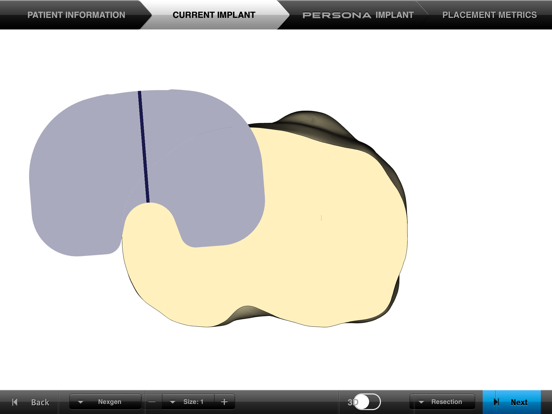 Screenshot #6 pour Persona® TKA Tibial Placement