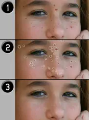 pimple eraser lite ipad resimleri 3