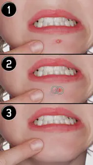 Pimple Eraser LITE iphone bilder 3