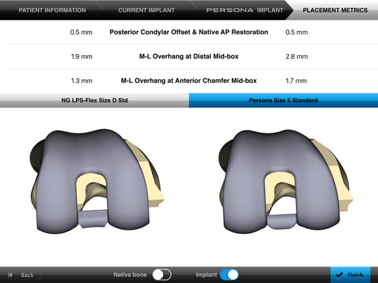 Screenshot #6 pour Persona® TKA Femoral Sizing