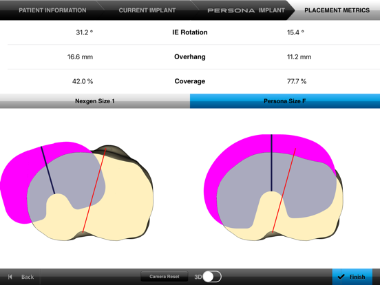 Screenshot #5 pour Persona® TKA Tibial Placement