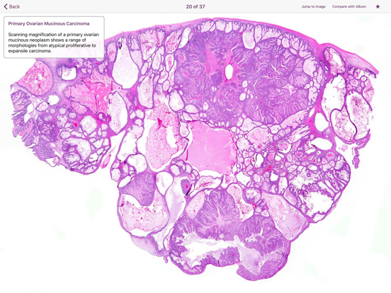 Screenshot #6 pour Ovarian Tumor Pathology