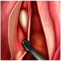 IPO Microcirurgia de Laringe
