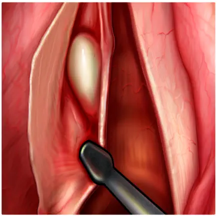 IPO Microcirurgia de Laringe Cheats