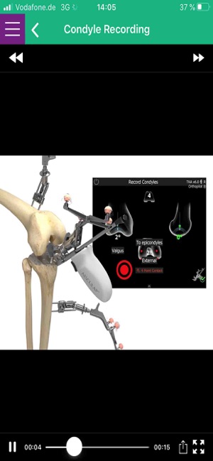 AESCULAP® OrthoPilot® Elite(圖3)-速報App