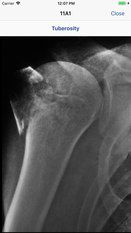 AO/OTA Fracture Classification screenshot-4