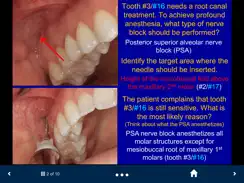 Dental Anesthesia-SecondLook iPad image 2