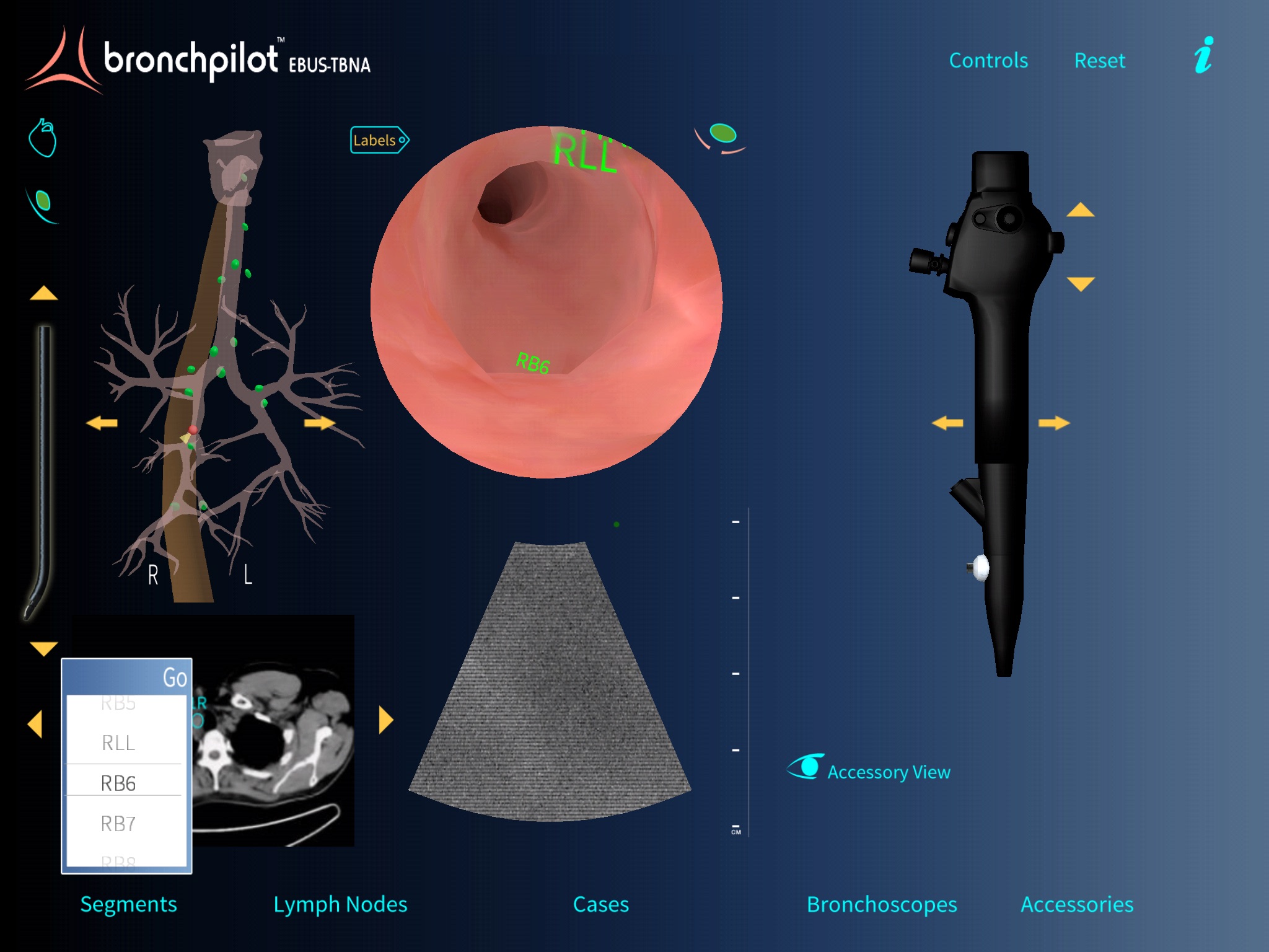 BronchPilot EBUS-TBNA screenshot 2