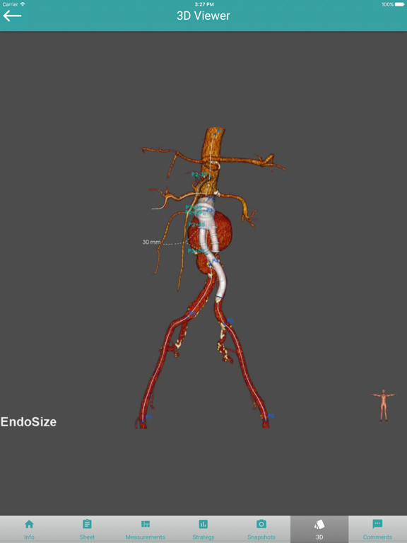 Screenshot #4 pour EndoSizeMe