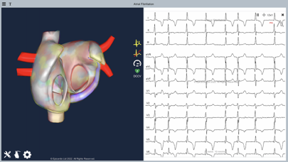 Atrial Fibrillation Screenshot