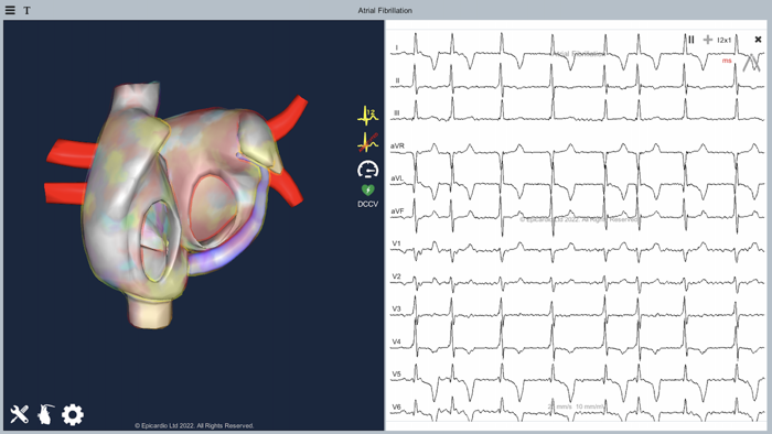 Atrial Fibrillation