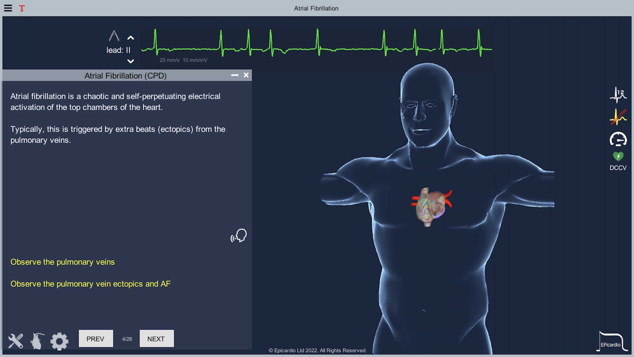 Atrial Fibrillationのおすすめ画像1