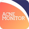 Acne Monitor