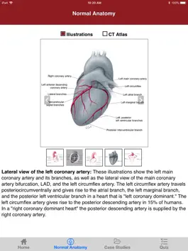 Game screenshot CTisus CT Coronary Arteries apk