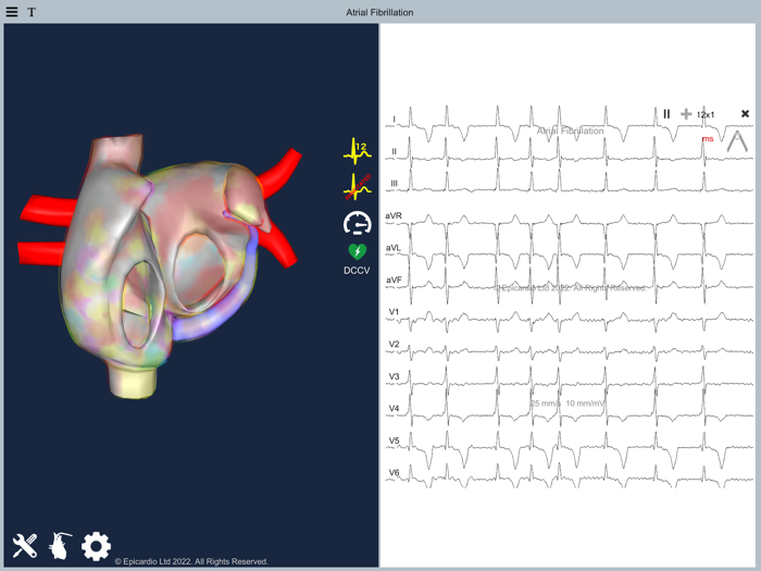 Atrial Fibrillation