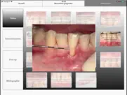 imuco récessions gingivales ipad resimleri 4