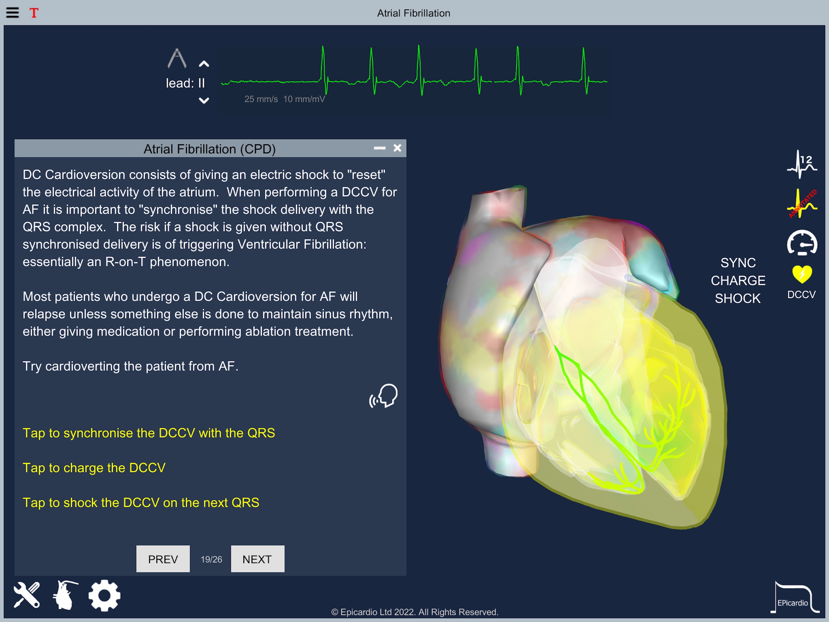 Atrial Fibrillationのおすすめ画像8