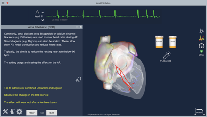 Atrial Fibrillation Screenshot